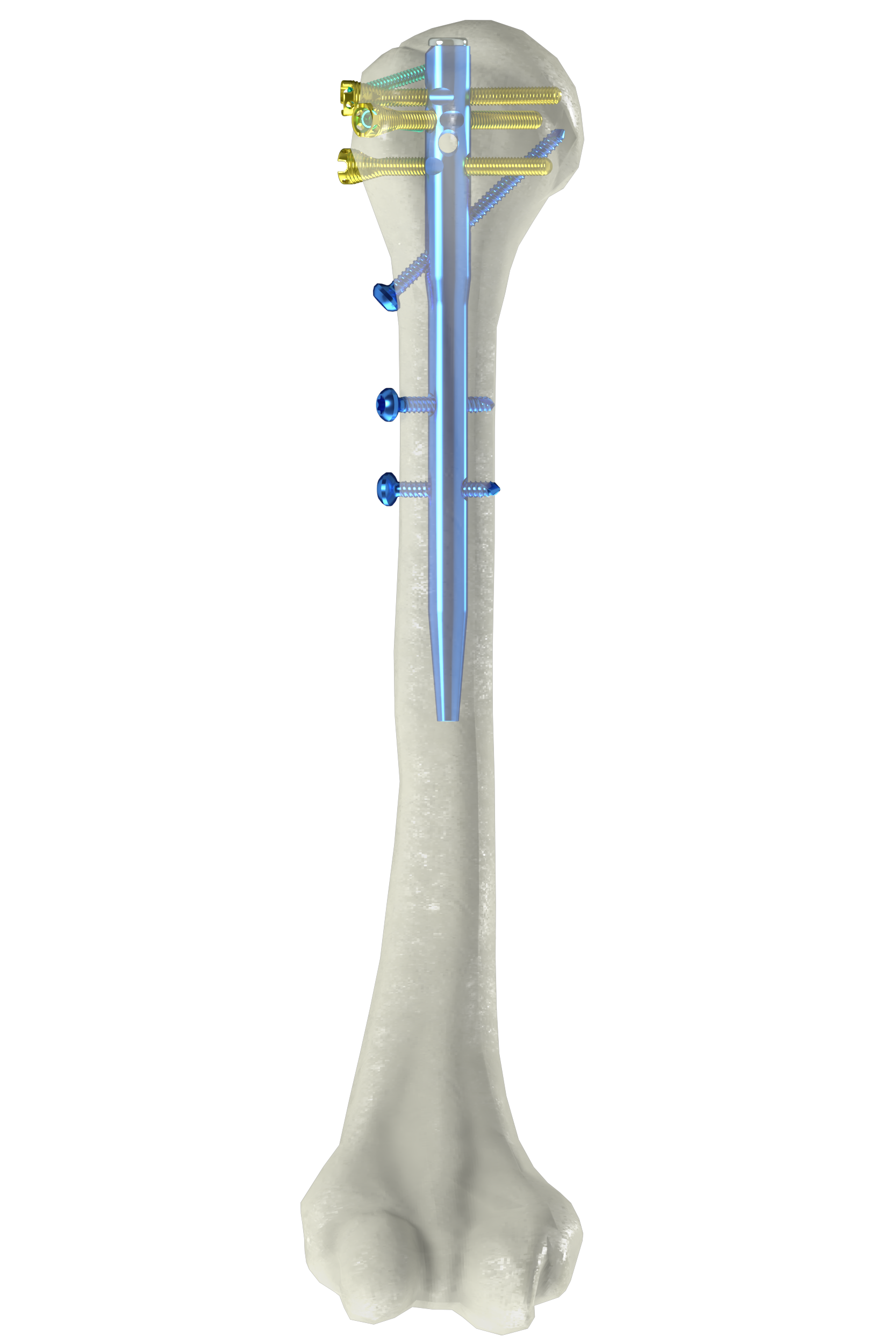 肱骨髓內(nèi)釘（NH-05）
